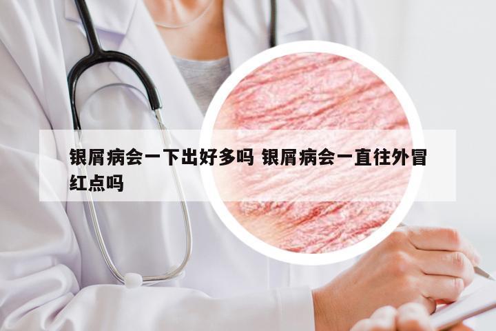 银屑病会一下出好多吗 银屑病会一直往外冒红点吗