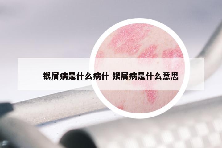 银屑病是什么病什 银屑病是什么意思