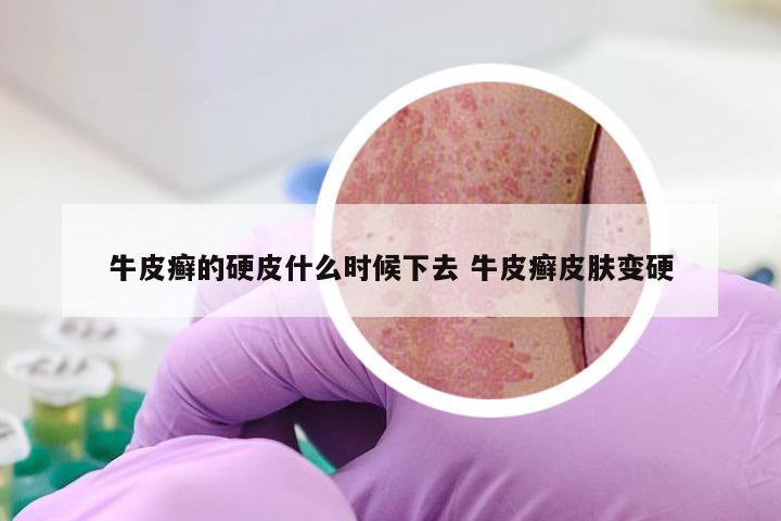 牛皮癣的硬皮什么时候下去 牛皮癣皮肤变硬