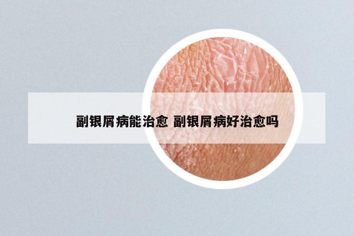 副银屑病能治愈 副银屑病好治愈吗