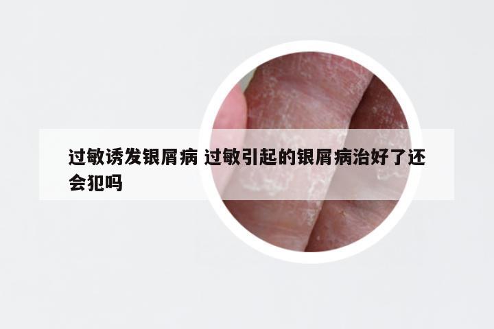 过敏诱发银屑病 过敏引起的银屑病治好了还会犯吗