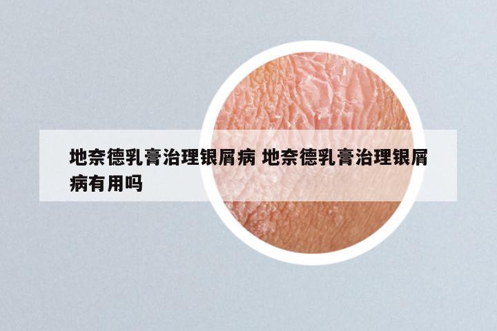 地奈德乳膏治理银屑病 地奈德乳膏治理银屑病有用吗