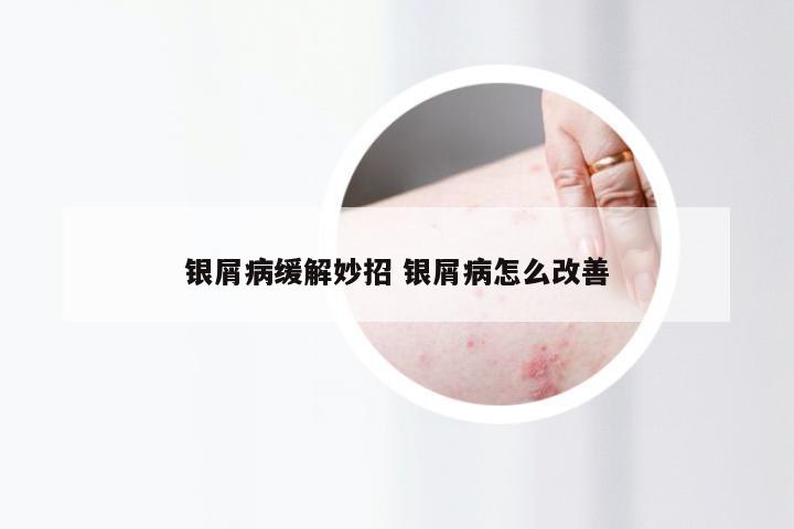 银屑病缓解妙招 银屑病怎么改善