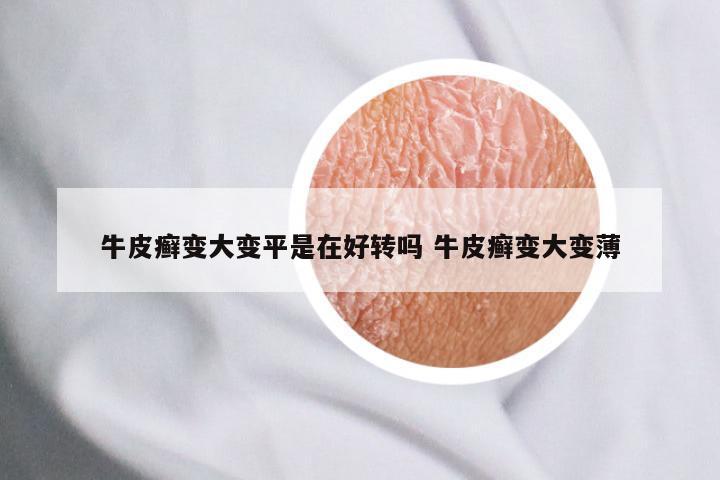 牛皮癣变大变平是在好转吗 牛皮癣变大变薄