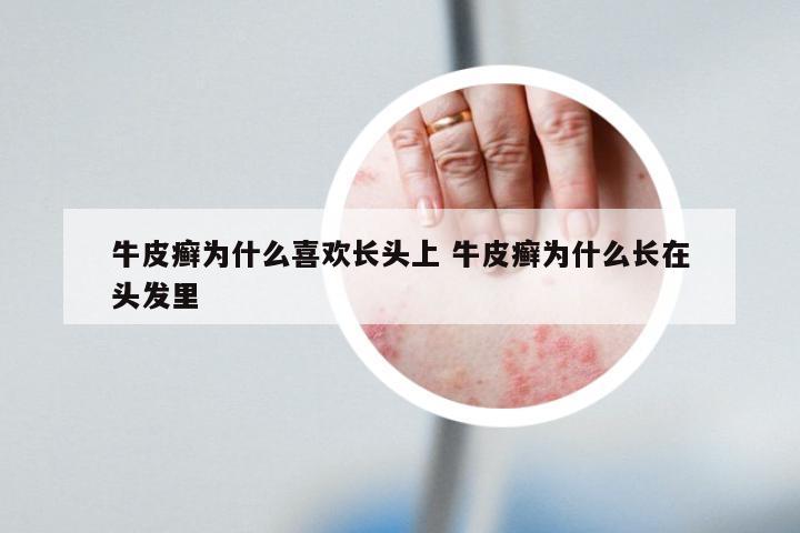 牛皮癣为什么喜欢长头上 牛皮癣为什么长在头发里