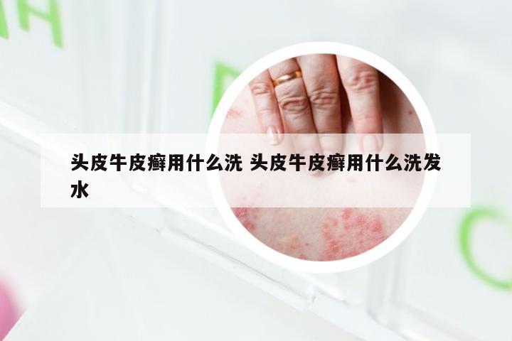 头皮牛皮癣用什么洗 头皮牛皮癣用什么洗发水