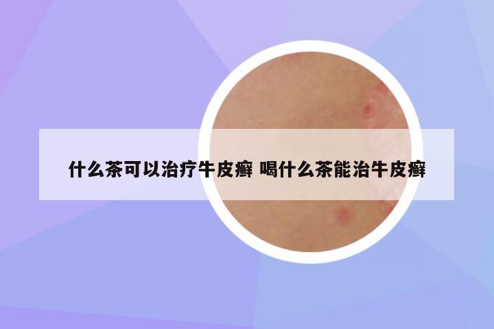 什么茶可以治疗牛皮癣 喝什么茶能治牛皮癣