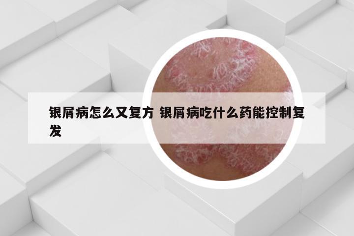 银屑病怎么又复方 银屑病吃什么药能控制复发