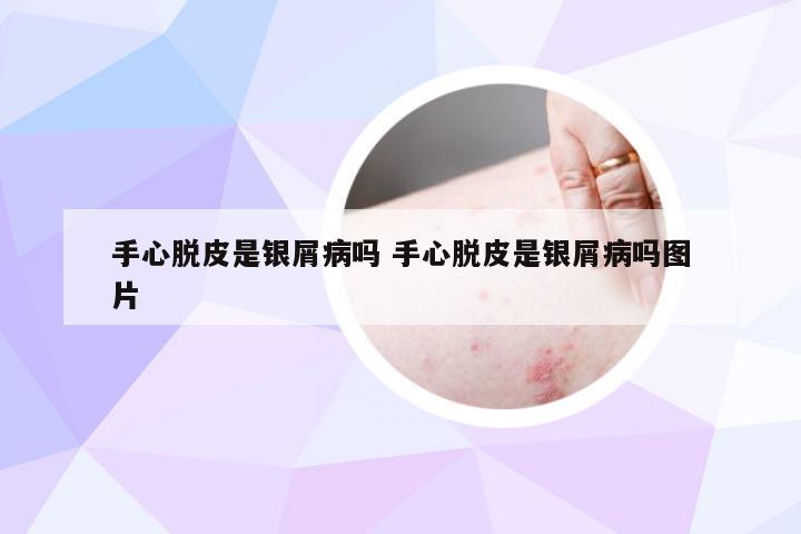 手心脱皮是银屑病吗 手心脱皮是银屑病吗图片