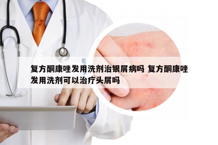 复方酮康唑发用洗剂治银屑病吗 复方酮康唑发用洗剂可以治疗头屑吗