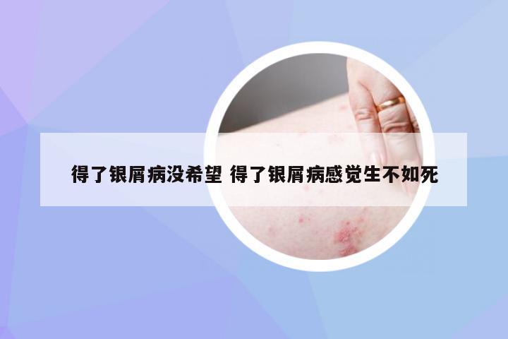 得了银屑病没希望 得了银屑病感觉生不如死