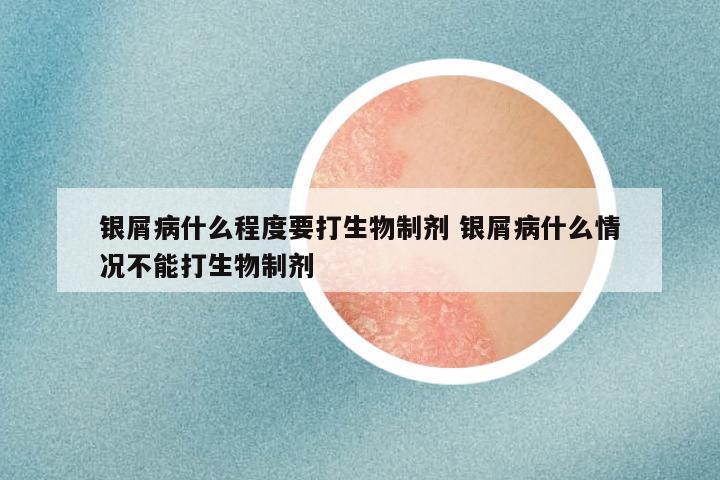 银屑病什么程度要打生物制剂 银屑病什么情况不能打生物制剂