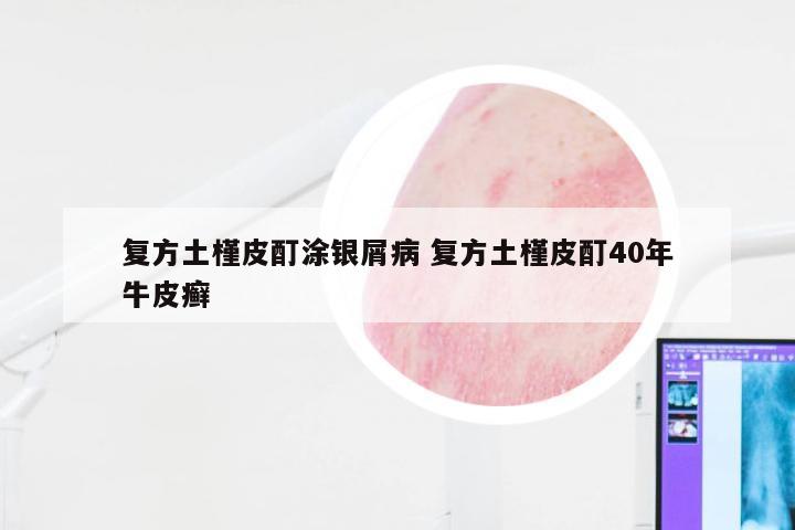 复方土槿皮酊涂银屑病 复方土槿皮酊40年牛皮癣