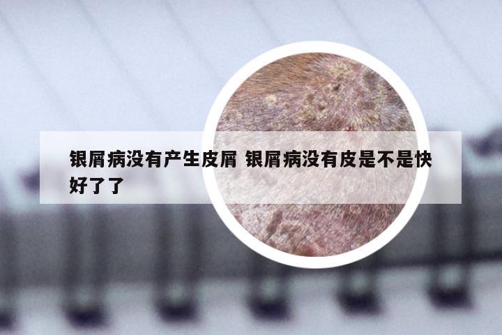 银屑病没有产生皮屑 银屑病没有皮是不是快好了了