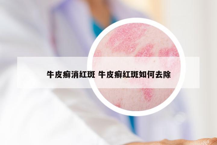 牛皮癣消红斑 牛皮癣红斑如何去除