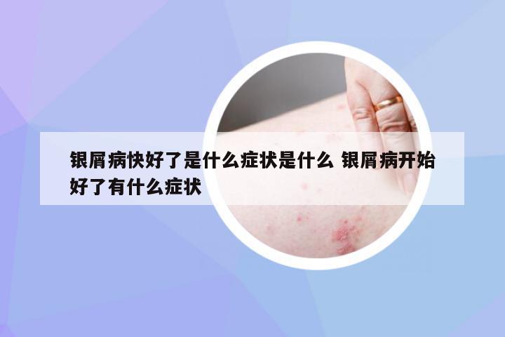 银屑病快好了是什么症状是什么 银屑病开始好了有什么症状