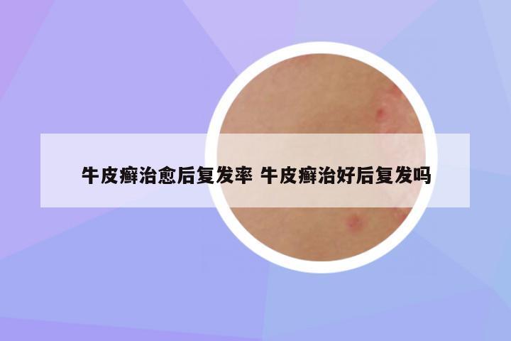 牛皮癣治愈后复发率 牛皮癣治好后复发吗