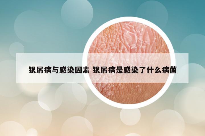 银屑病与感染因素 银屑病是感染了什么病菌