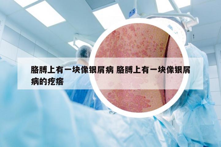 胳膊上有一块像银屑病 胳膊上有一块像银屑病的疙瘩
