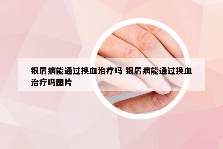 银屑病能通过换血治疗吗 银屑病能通过换血治疗吗图片