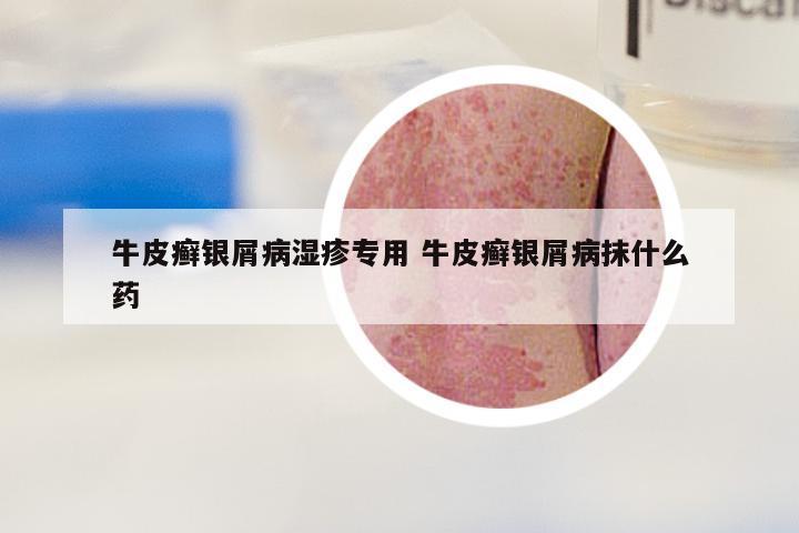 牛皮癣银屑病湿疹专用 牛皮癣银屑病抹什么药