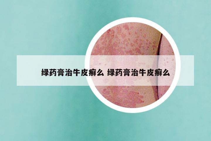 绿药膏治牛皮癣么 绿药膏治牛皮癣么