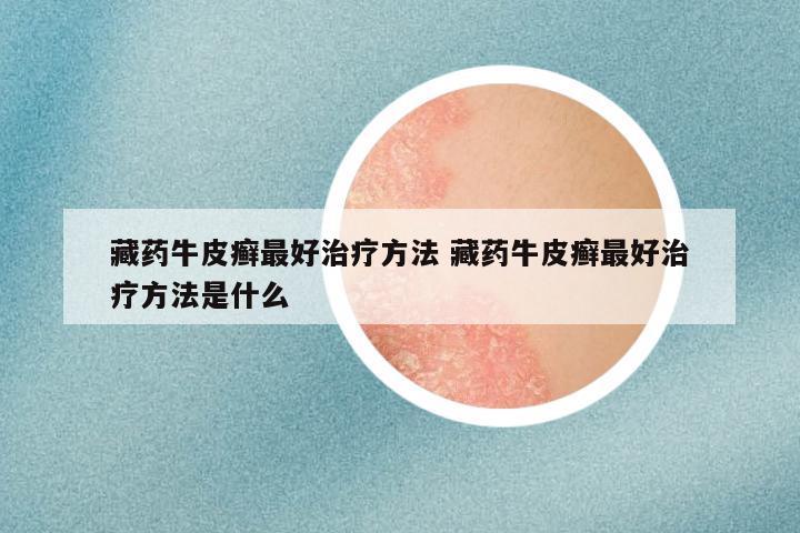 藏药牛皮癣最好治疗方法 藏药牛皮癣最好治疗方法是什么