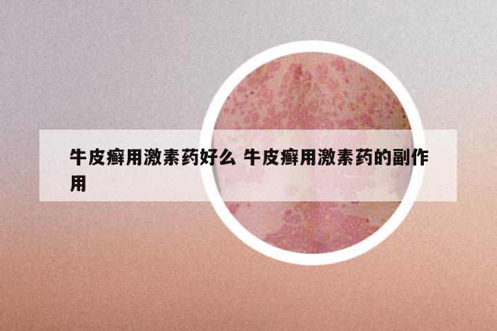 牛皮癣用激素药好么 牛皮癣用激素药的副作用