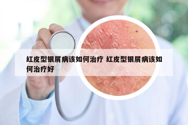 红皮型银屑病该如何治疗 红皮型银屑病该如何治疗好
