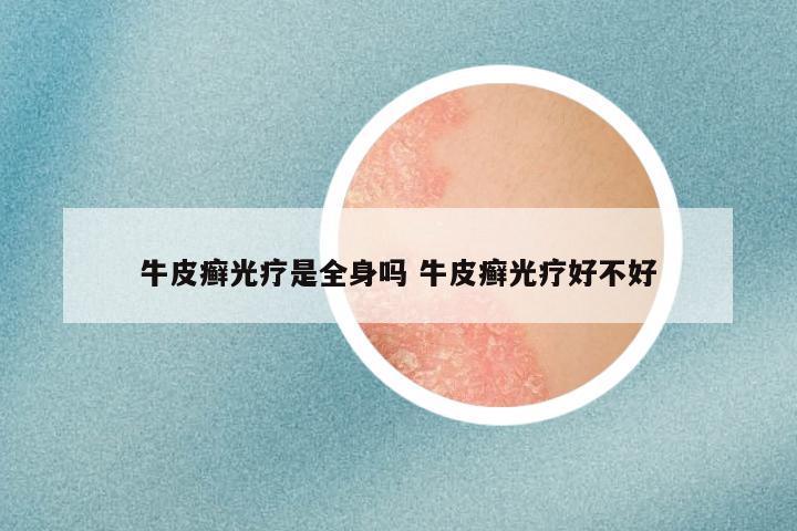 牛皮癣光疗是全身吗 牛皮癣光疗好不好
