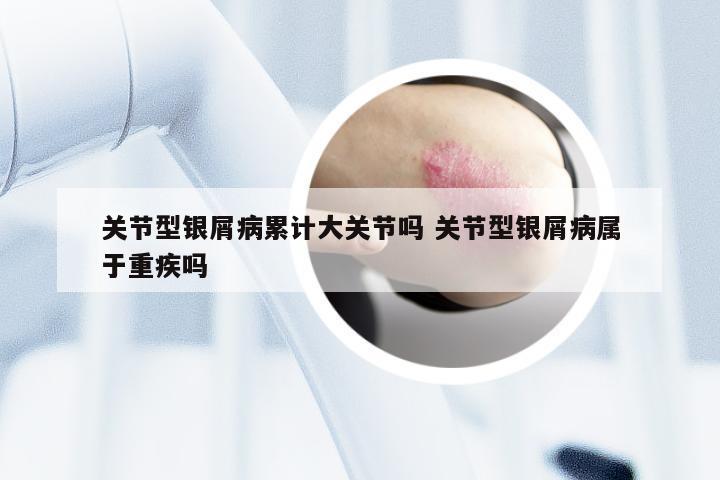 关节型银屑病累计大关节吗 关节型银屑病属于重疾吗