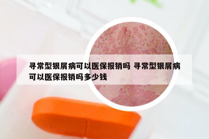 寻常型银屑病可以医保报销吗 寻常型银屑病可以医保报销吗多少钱