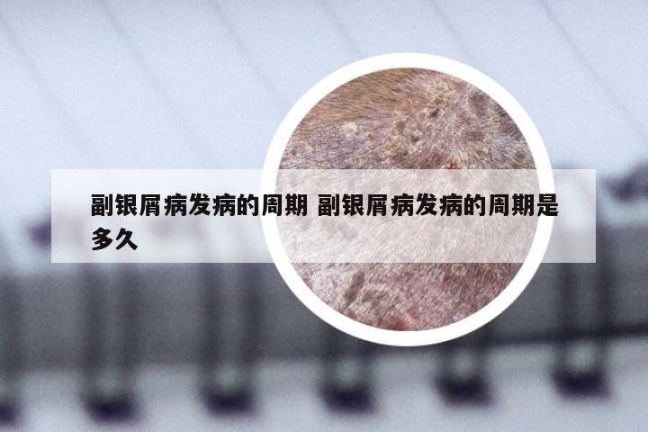 副银屑病发病的周期 副银屑病发病的周期是多久
