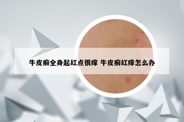 牛皮癣全身起红点很痒 牛皮癣红痒怎么办