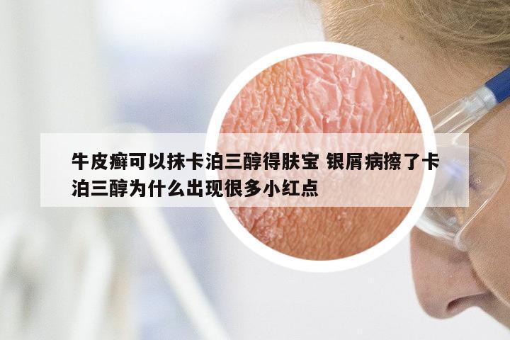 牛皮癣可以抹卡泊三醇得肤宝 银屑病擦了卡泊三醇为什么出现很多小红点