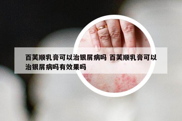 百芙顺乳膏可以治银屑病吗 百芙顺乳膏可以治银屑病吗有效果吗