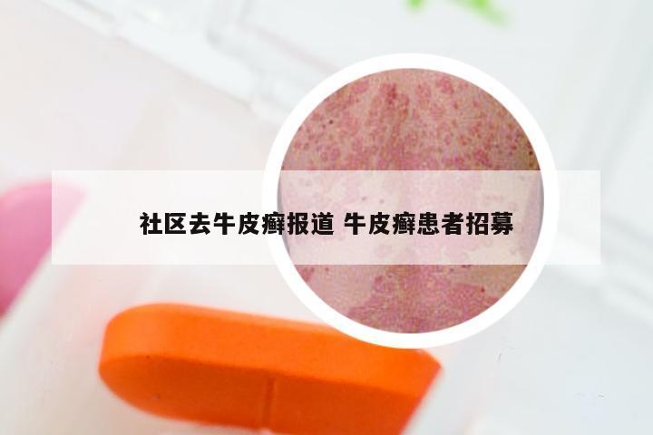 社区去牛皮癣报道 牛皮癣患者招募