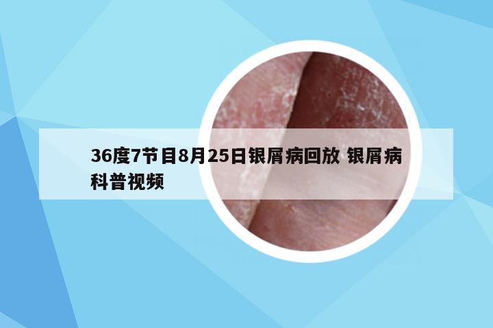 36度7节目8月25日银屑病回放 银屑病科普视频