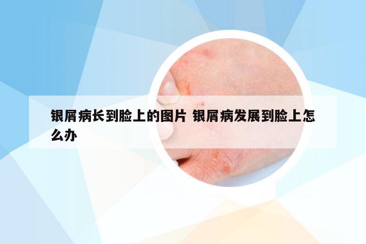 银屑病长到脸上的图片 银屑病发展到脸上怎么办