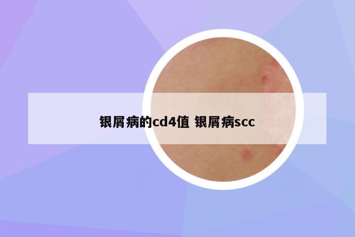 银屑病的cd4值 银屑病scc