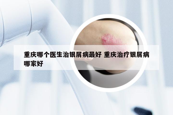 重庆哪个医生治银屑病最好 重庆治疗银屑病哪家好