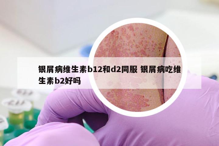 银屑病维生素b12和d2同服 银屑病吃维生素b2好吗