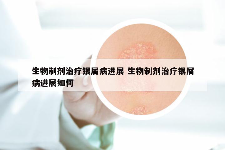 生物制剂治疗银屑病进展 生物制剂治疗银屑病进展如何