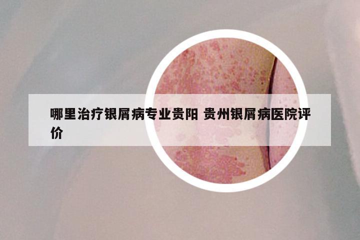 哪里治疗银屑病专业贵阳 贵州银屑病医院评价