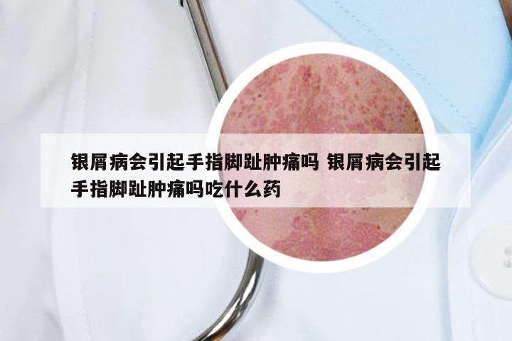 银屑病会引起手指脚趾肿痛吗 银屑病会引起手指脚趾肿痛吗吃什么药