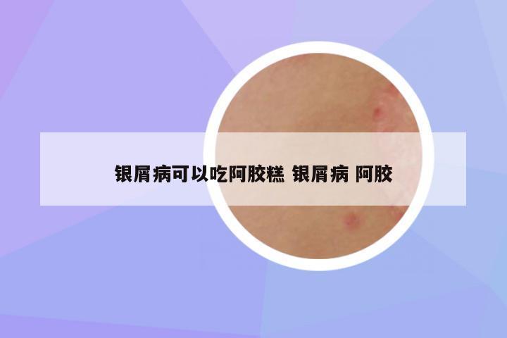 银屑病可以吃阿胶糕 银屑病 阿胶