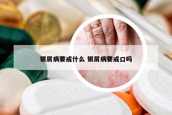 银屑病要戒什么 银屑病要戒口吗