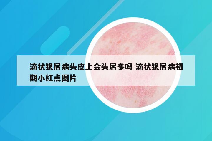 滴状银屑病头皮上会头屑多吗 滴状银屑病初期小红点图片