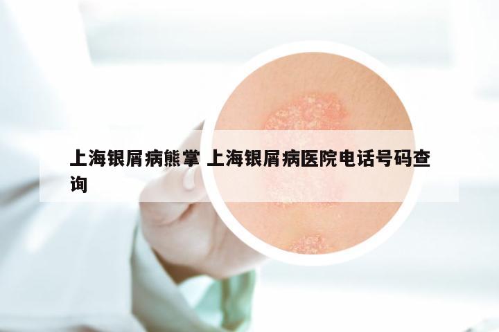 上海银屑病熊掌 上海银屑病医院电话号码查询