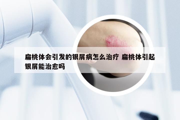 扁桃体会引发的银屑病怎么治疗 扁桃体引起银屑能治愈吗